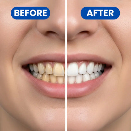 Teeth Whitening Strips